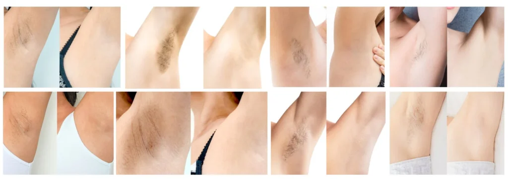 Vorher-Nachher-Ergebnis mit SilkyPlanet IPL Haarentfernung – sichtbare Ergebnisse nach wenigen Wochen.